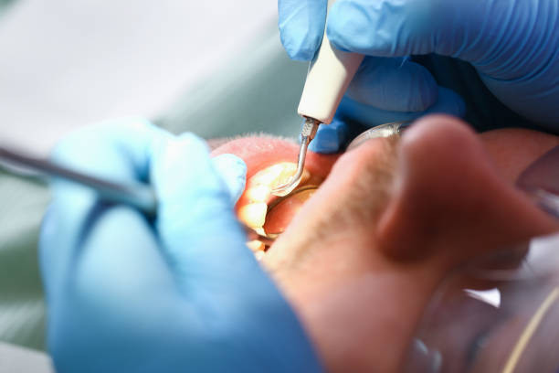 Best Emergency Wisdom Teeth Removal in Newberry, SC